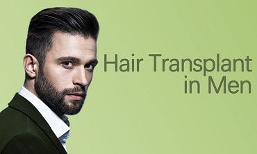 Hair Transplant in Men