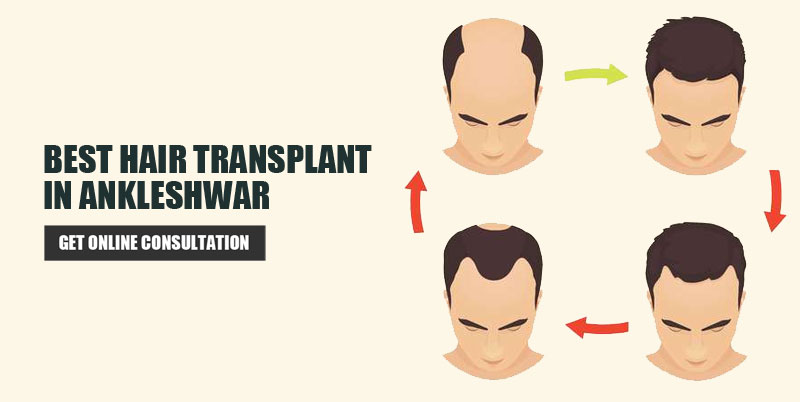Hair Transplant Ankleshwar