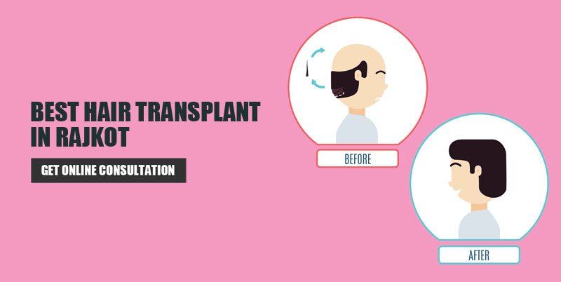 Hair Transplant Rajkot