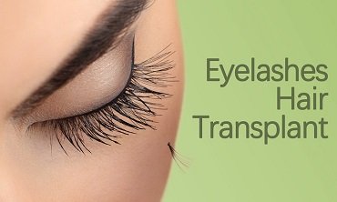 Eyelashes Hair Transplant